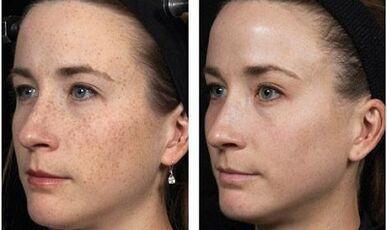 Fotos de antes e despois de rexuvenecemento facial fraccionado