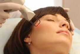 a esencia do procedemento para o rexuvenecemento fraccionado da pel facial con láser