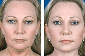 antes e despois do rexuvenecemento facial con láser